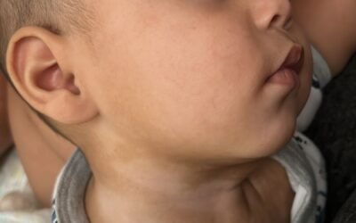 Dermatitis Atópica en la Piel de tu Bebé: 5 Consejos para aliviarla